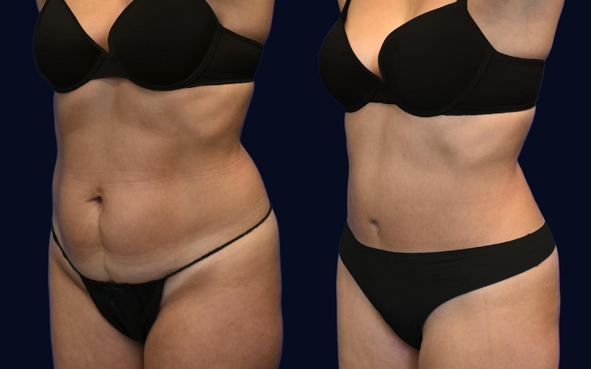 Abdominoplasty (Tummy Tuck) Before & After Gallery - Patient 137891 - Image 2