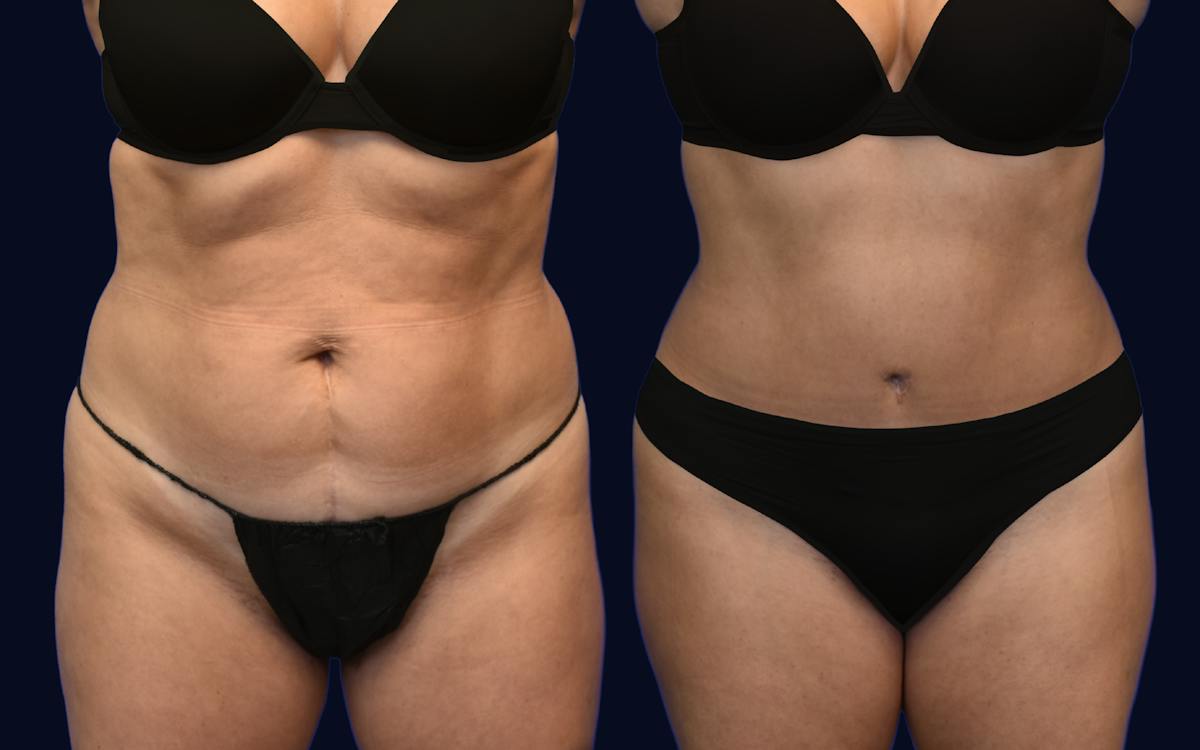 Abdominoplasty (Tummy Tuck) Before & After Gallery - Patient 137891 - Image 1