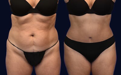 Abdominoplasty (Tummy Tuck) Before & After Gallery - Patient 137891 - Image 1