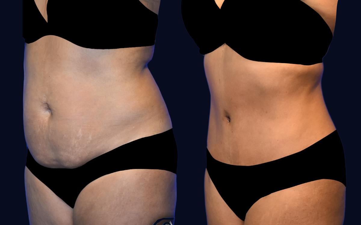 Abdominoplasty (Tummy Tuck) Before & After Gallery - Patient 297428 - Image 2