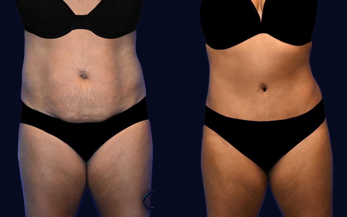 Abdominoplasty (Tummy Tuck) Before & After Gallery - Patient 297428 - Image 1