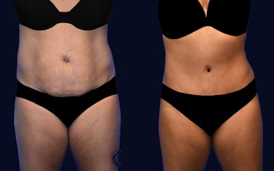 Abdominoplasty (Tummy Tuck) Before & After Gallery - Patient 297428 - Image 1
