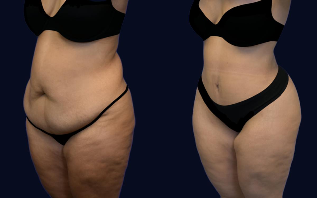 Abdominoplasty (Tummy Tuck) Before & After Gallery - Patient 314767 - Image 2