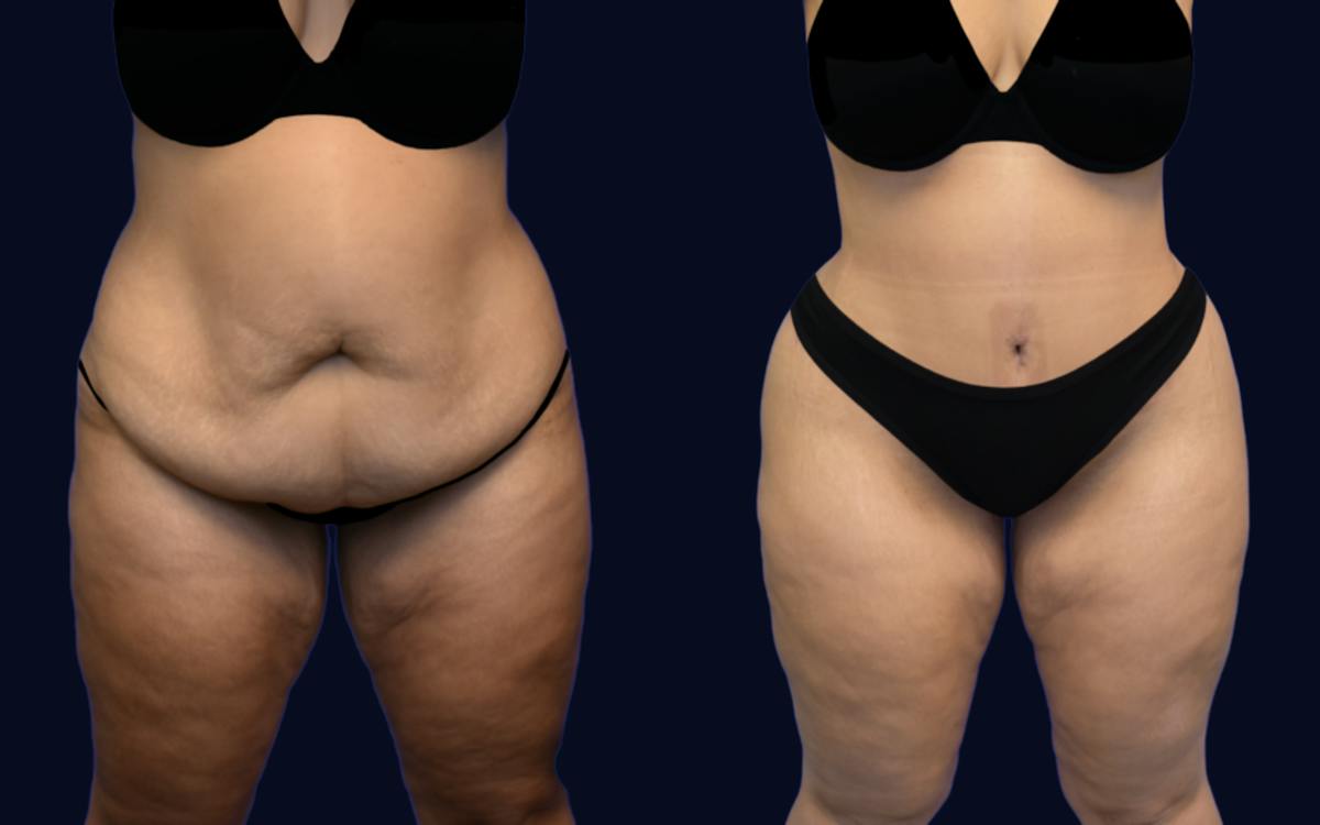 Abdominoplasty (Tummy Tuck) Before & After Gallery - Patient 314767 - Image 1