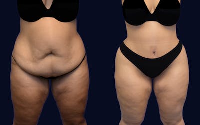 Abdominoplasty (Tummy Tuck) Before & After Gallery - Patient 314767 - Image 1