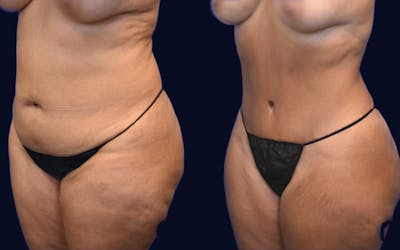 Abdominoplasty (Tummy Tuck) Before & After Gallery - Patient 401209 - Image 1