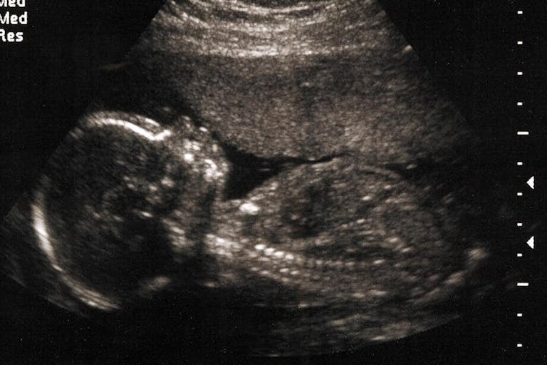 20 weeks, abortion, media