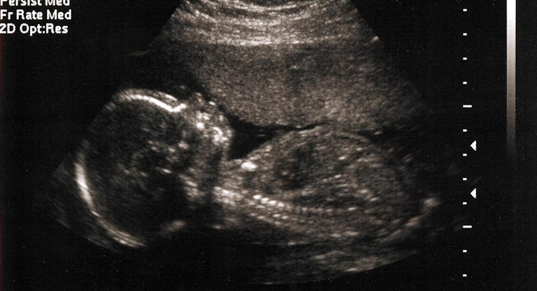 20 weeks, abortion, media