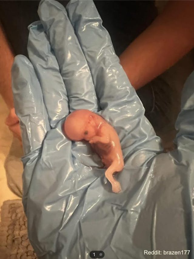 Photo: Reddit user brazen 177 (preborn baby 10 weeks dated by ultrasound) ‘I just want my baby back’: Reddit poster shares traumatic abortion pill experience image