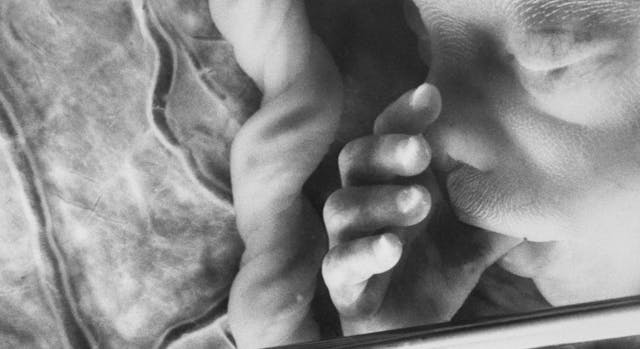 (Original Caption) The needle telescope is inserted into the womb under local anesthetic. It is used so that doctors can control the attached syringe with accuracy. The blood sample is then taken from the placenta.  . (Getty Images) lawsuit, fetal pain, 18 weeks