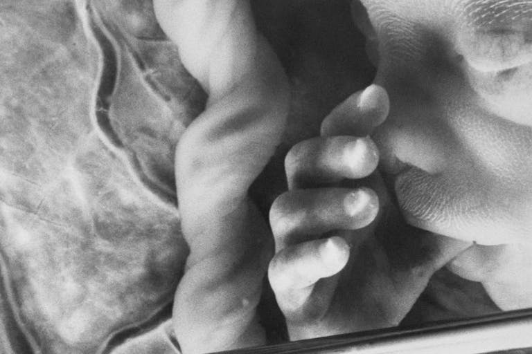 (Original Caption) The needle telescope is inserted into the womb under local anesthetic. It is used so that doctors can control the attached syringe with accuracy. The blood sample is then taken from the placenta. . (Getty Images) lawsuit, fetal pain, 18 weeks
