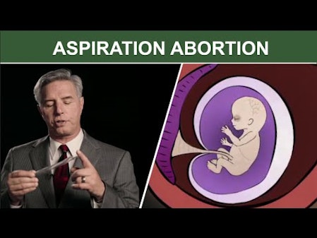 1st Trimester Surgical Abortion: Suction (Aspiration) D & C thumbnail