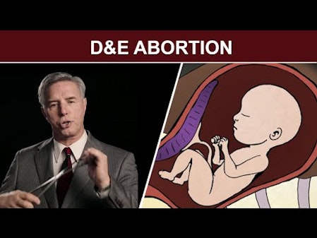 2nd Trimester Surgical Abortion: Dilation and Evacuation (D & E) thumbnail