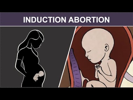 3rd Trimester Induction Abortion: Injection and Stillbirth thumbnail