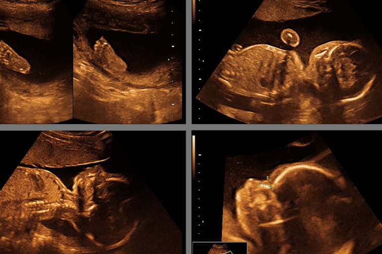 baby on ultrasound in the abdomen of a pregnant