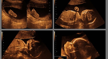 baby on ultrasound in the abdomen of a pregnant