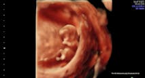 9 weeks 5 days (4-D Ultrasound Lady)