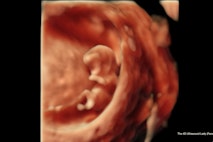 9 weeks 5 days (4-D Ultrasound Lady)