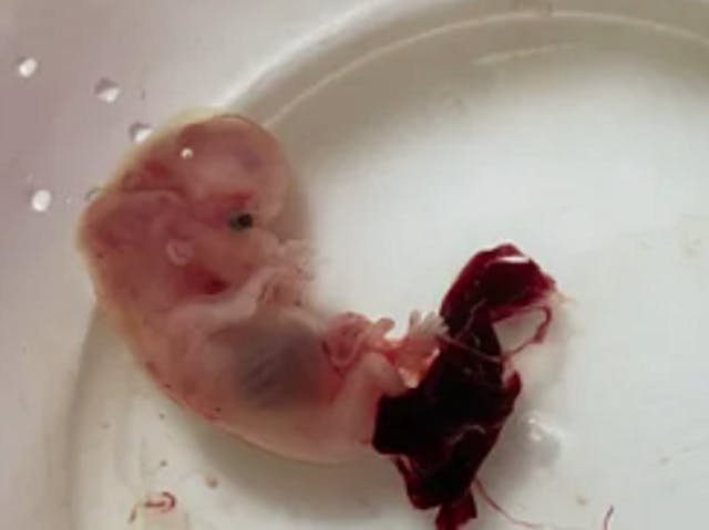 EXCLUSIVE: Undercover video shows Virginia abortionist saying it’s ‘easy’ to dismember babies image