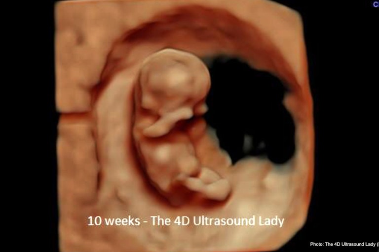 abortion pill reversal