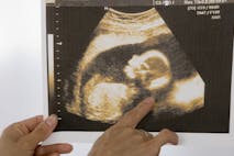 Gallup, Ireland, preborn, autism