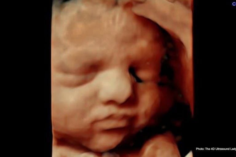 32 wks gestation – 4D Ultrasound Lady