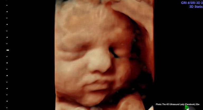 32 wks gestation – 4D Ultrasound Lady
