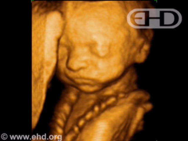 Preborn child on ultrasound at 20 weeks Chrissy Teigen writes about losing her son at 20 weeks: ‘I can feel the pain all over again’ image