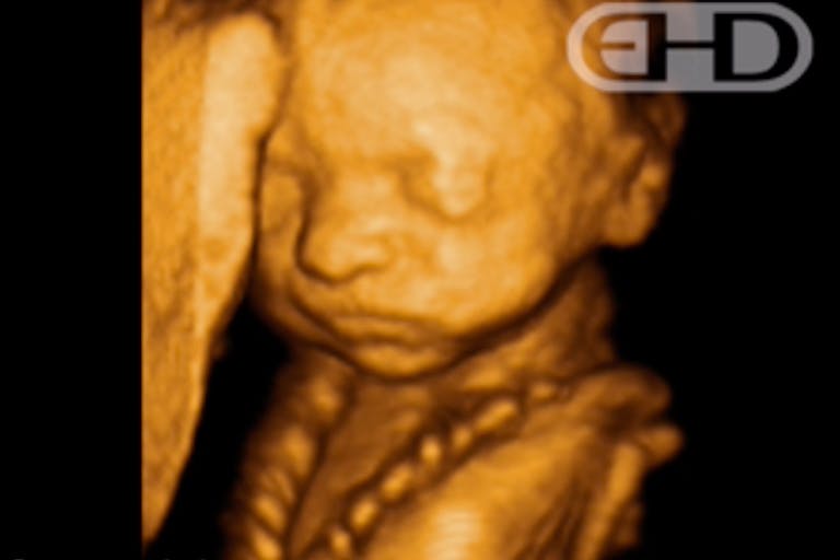 Preborn child on ultrasound at 20 weeks Chrissy Teigen writes about losing her son at 20 weeks: ‘I can feel the pain all over again’ image