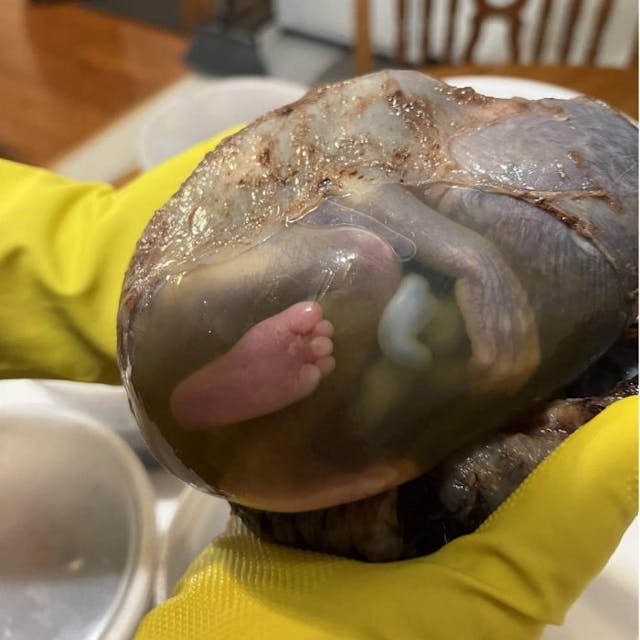 Baby en caul 1 Despite what ‘Time’ claims, this is what it really means to get an abortion after ‘fetal viability’ image