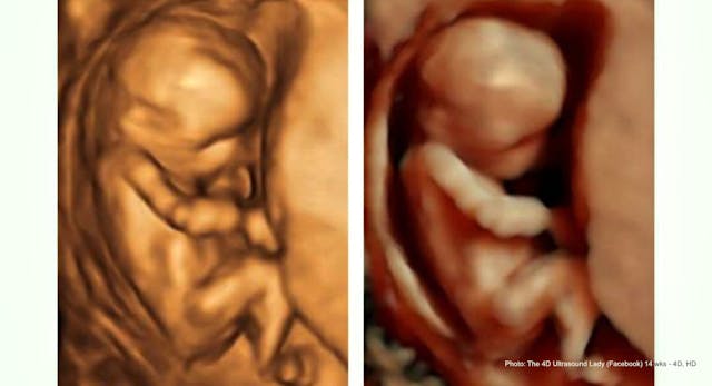 14 weeks gestation, 4D/HD comparison After an abortion and miscarriage, God opened her eyes to the truth image