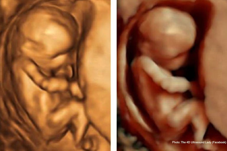 14 weeks gestation, 4D/HD comparison After an abortion and miscarriage, God opened her eyes to the truth image