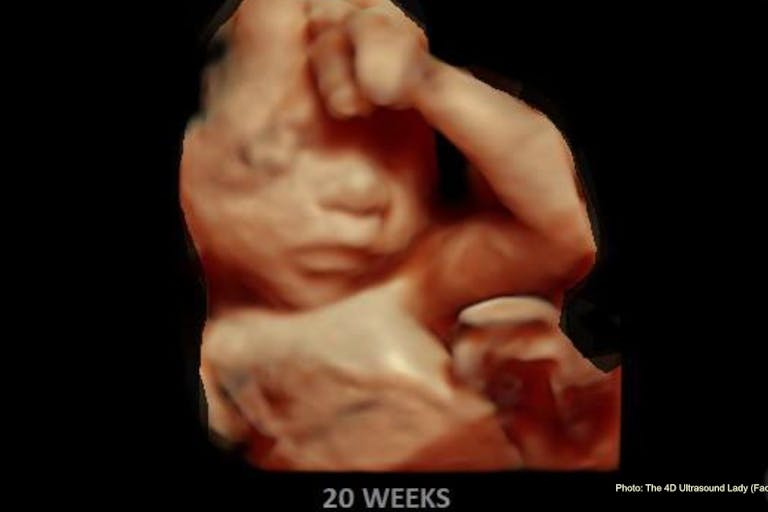 20 wks gestation – 4D Ultrasound Lady Norwegian parents speak out against pressure to abort children with Down syndrome featured image