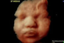 Photo: 37 weeks (4D Ultrasound Lady/Facebook) 37 weeks 4D Ultrasound Lady