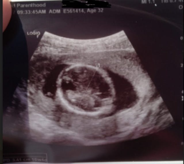 16 weeks 4 days (top of baby’s head only) – Planned Parenthood’s attempt at deceiving patient Planned Parenthood’s history of failing to obtain informed consent from women image