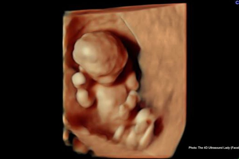 11 weeks 6 days – 4D Ultrasound Lady Mexican state of Yucatán is country’s latest to decriminalize abortion featured image