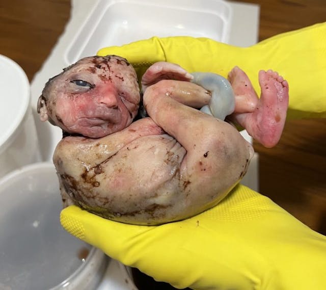 Image of baby killed by abortion.