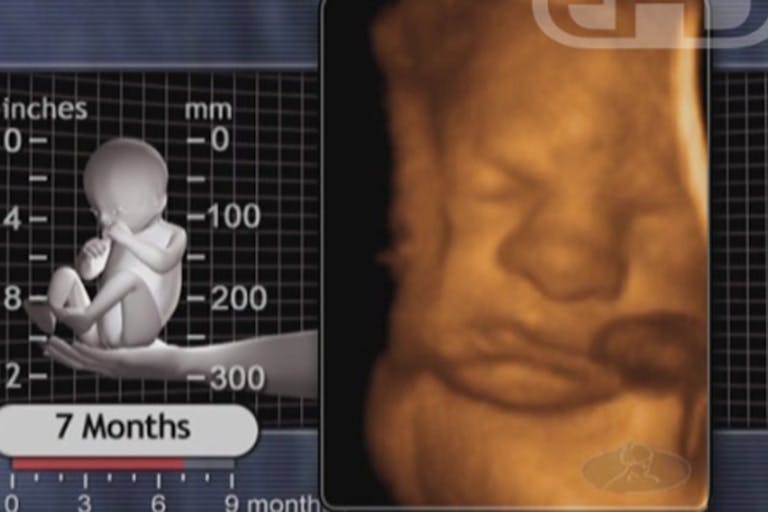Gosnell, stillborn, 7 months