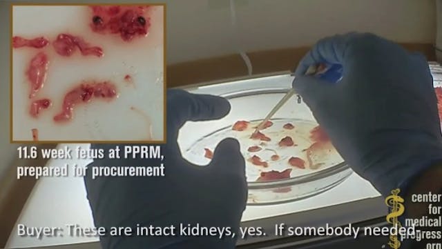 11.6 week preborn child harvested at Planned Parenthood of the Rocky Mountains (screenshot: Center for Medical Progress) DEFUND Planned Parenthood: Dehumanizing preborn children while harvesting their body parts image