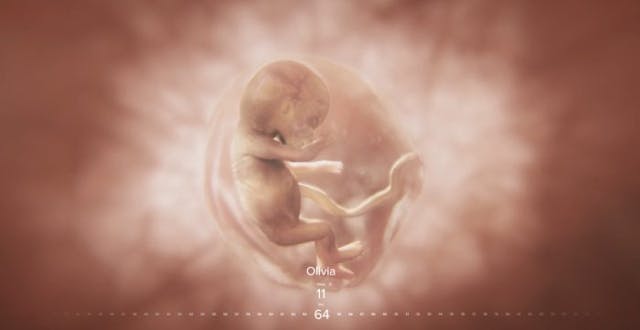 Baby Olivia, 11 weeks post-fertilization (13 weeks LMP) Iowa, Baby Olivia, prenatal development