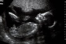 ultrasound, viability, abortion, Russia