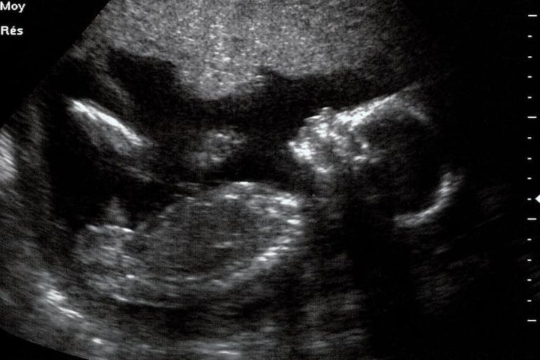 ultrasound, viability, abortion, Russia