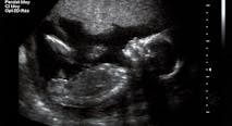 ultrasound, viability, abortion, Russia