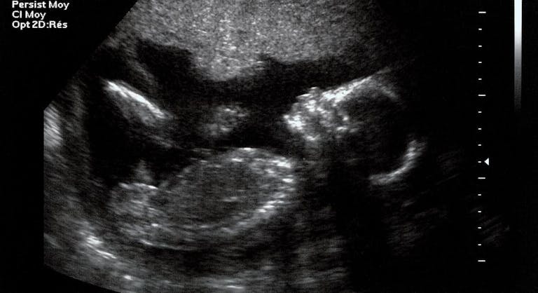 ultrasound, viability, abortion, Russia