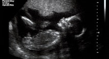 ultrasound, viability, abortion, Russia