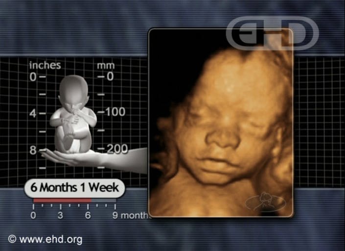 25 weeks EHD