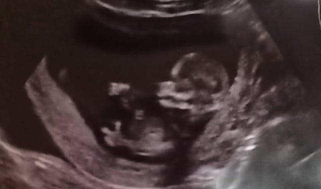 a reassuring ultrasound (Emma)