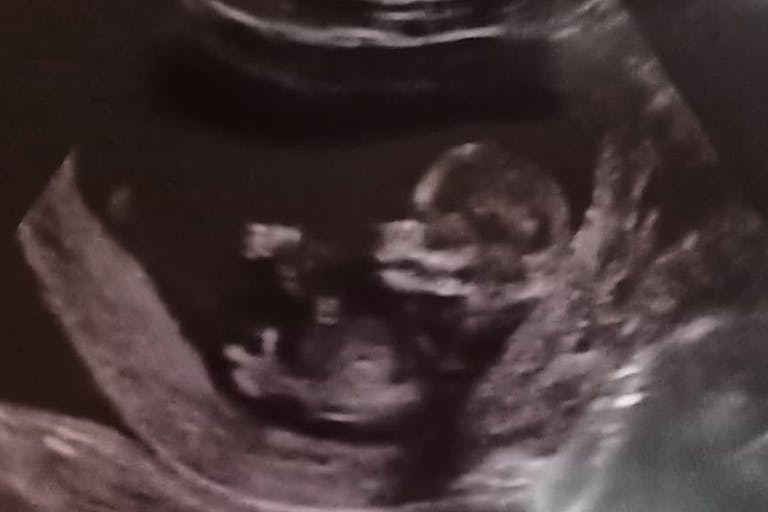 a reassuring ultrasound (Emma)