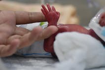 abortion survivors, premature, preemie,