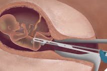 abortion, Live Action, prenatal diagnosis, kansas, late abortion, abortion, D&E